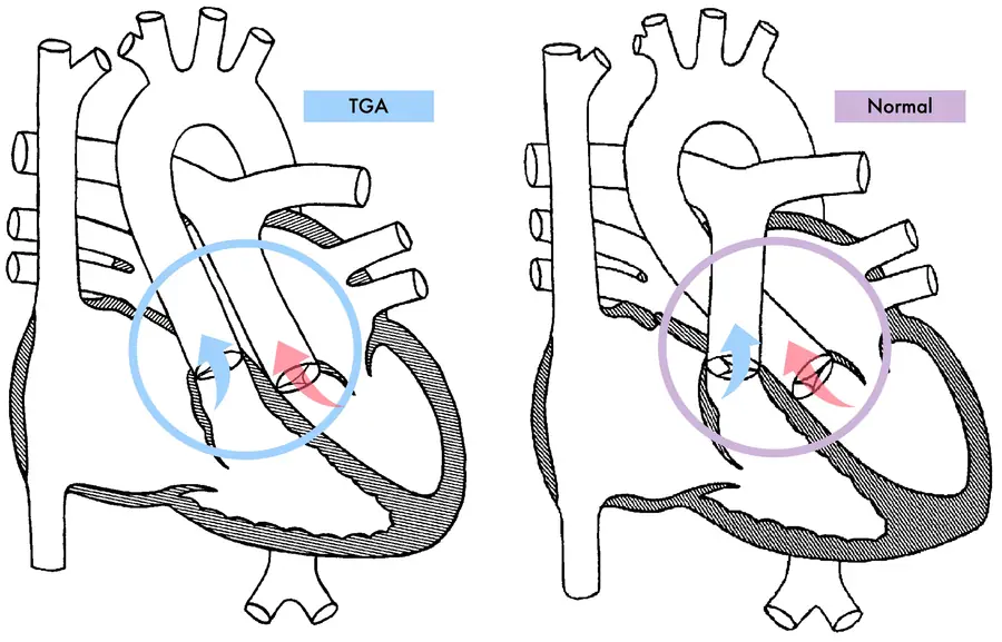 Transposición de Grandes Arterias 2