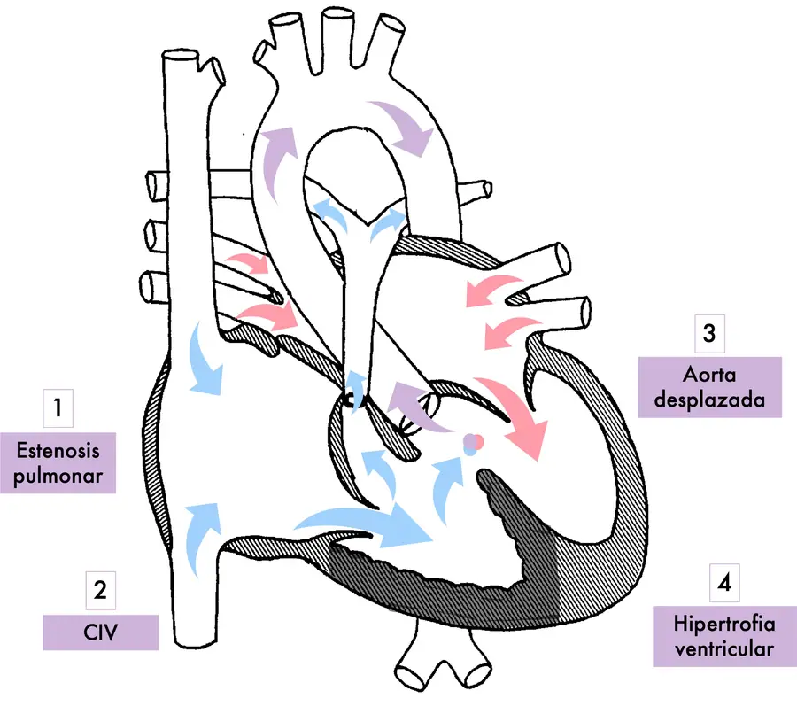 Tetralogía de Fallot 2